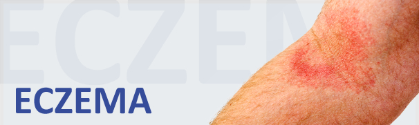 hdr_eczema1
